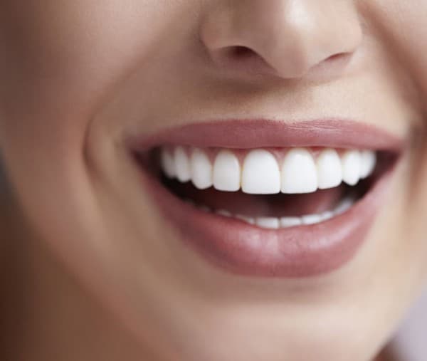 Have you considered dental Veneers?