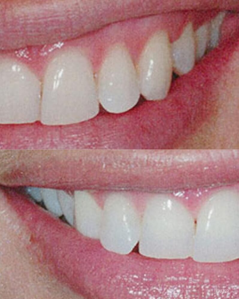 Whitening before and after example