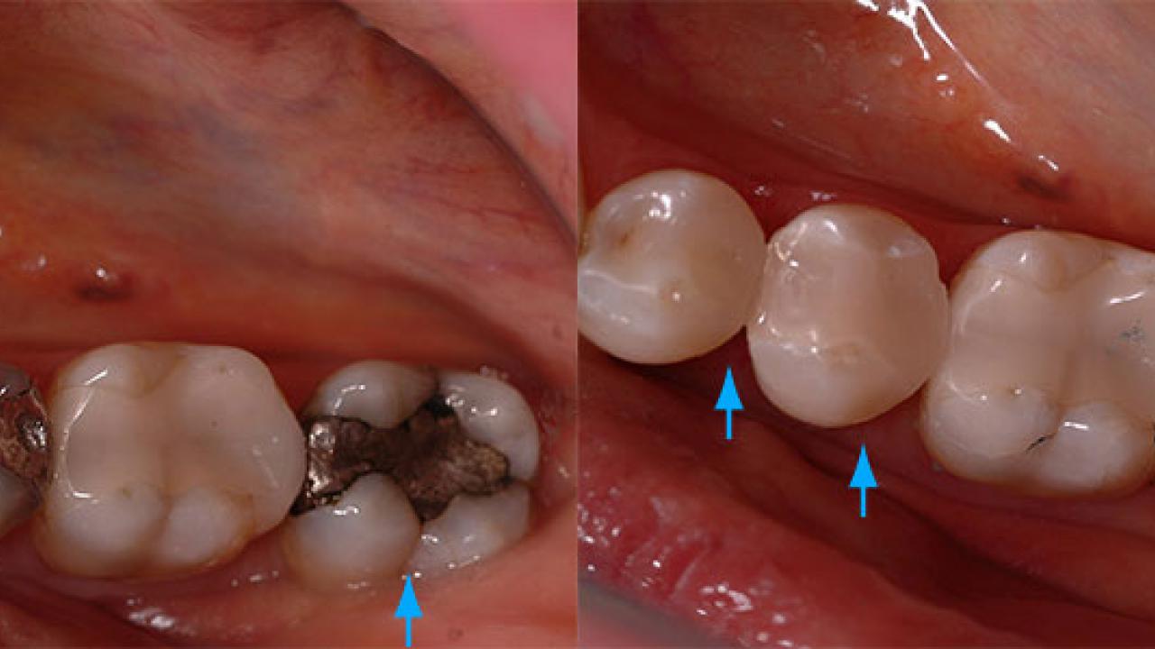 cerec5